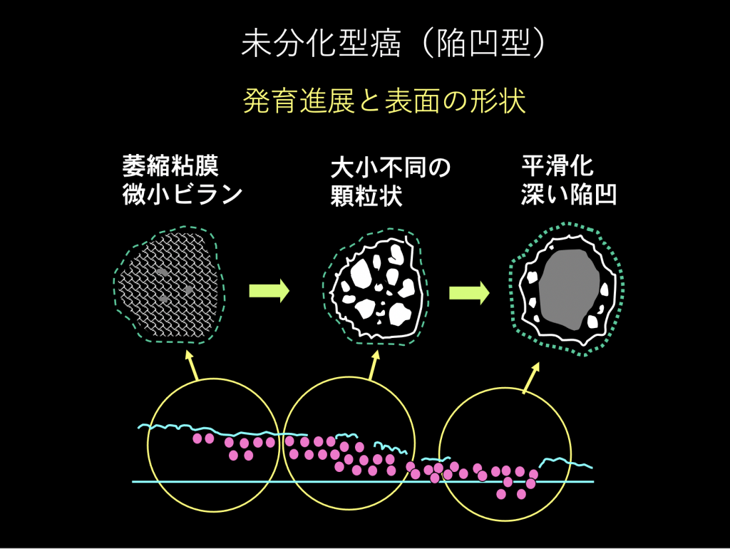 中古】発見例100例にみる胃癌X線診断の究極：オマツリライフ別館+